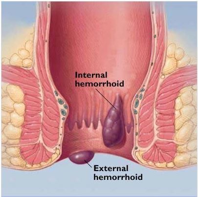 Haemorrhoids Diagram photo Haemorrhoidsdiag_zps94c315f7.jpg